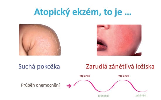 atopicky ekzem definice cs